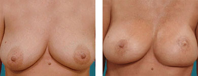 breast cancer breast reconstruction