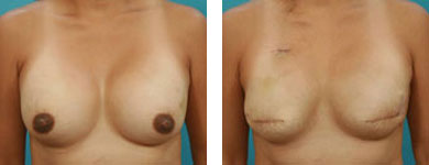 elliott breast reconstruction patient