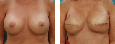 post breast augmentation procedure