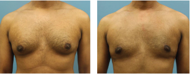 4-Male-breast-reduction-atlanta-alpharetta-georgia-ga