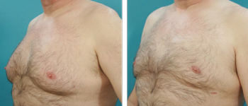 7-Male-breast-reduction-atlanta-alpharetta-georgia-ga