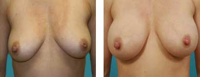 breast augmentation atlanta ga