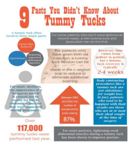 Tummy Tuck information