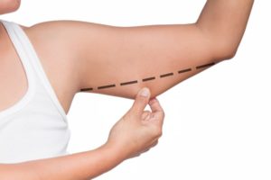 Minimizing Arm Lift Scars