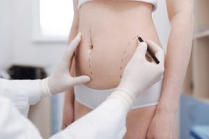 How Do I Maintain My Results After Liposuction