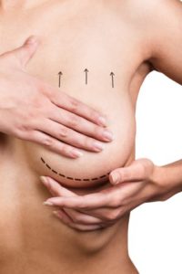 Ask Dr. Elliott What is the Difference Between a Breast Reduction and Breast Lift