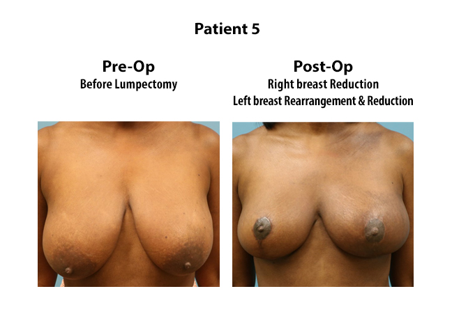 breast surgery atlanta ga