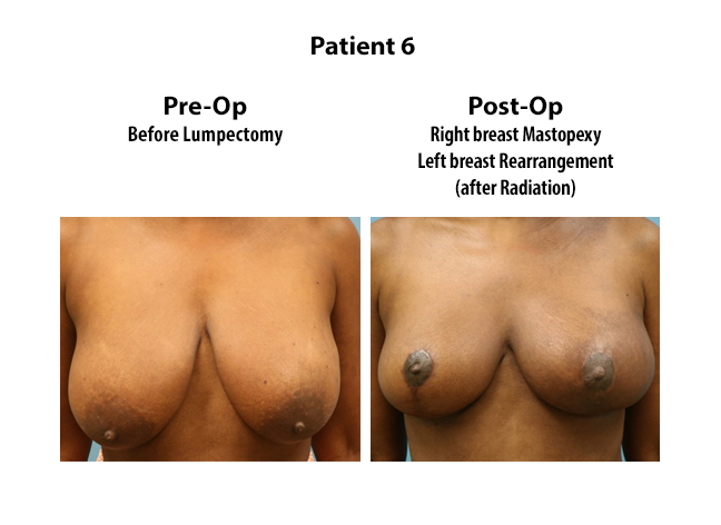 breast surgery atlanta ga