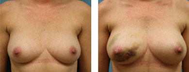 Autologous-Fat-breast-augmentation
