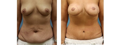 Bilateral Breast Reconstruction with TRAM flaps 1