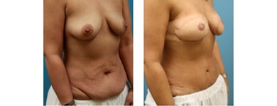 Bilateral Breast Reconstruction with TRAM flaps 2