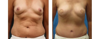 Bilateral Breast Reconstruction with TRAM flaps A1