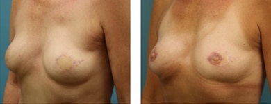 Bilateral Breast Reconstruction with TRAM flaps A2