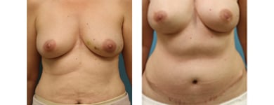 Bilateral Breast Reconstruction with TRAM flaps B1