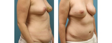 Bilateral Breast Reconstruction with TRAM flaps B2