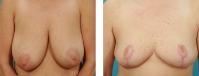 Bilateral Breast Reduction 1