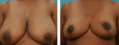 Bilateral Breast Reduction 