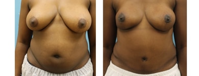 Bilateral TRAM flaps – with nipple areolar sparing