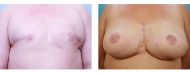 Bilateral latissimus dorsi Breast Reconstruction