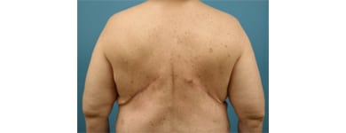 Bilateral latissimus dorsi Breast Reconstruction – Donor sites