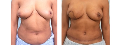 TRAM breast reconstruction