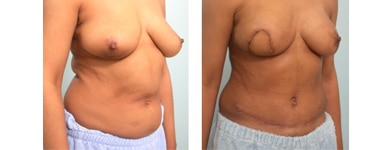 TRAM breast reconstruction