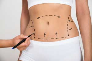 surgeon-outlines-female-belly