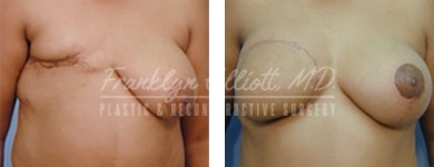 breast cancer breast reconstruction