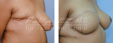 breast cancer breast reconstruction