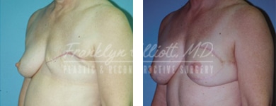 breast cancer breast reconstruction